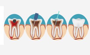 ενδοδοντία, ενδοδοντική θεραπεία, απονεύρωση, σύγχρονη οδοντιατρική, λιάπης, οδοντιατρείο, οδοντιατρική κλινική, οδοντίατρος γαλάτσι